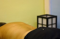 acupuntura